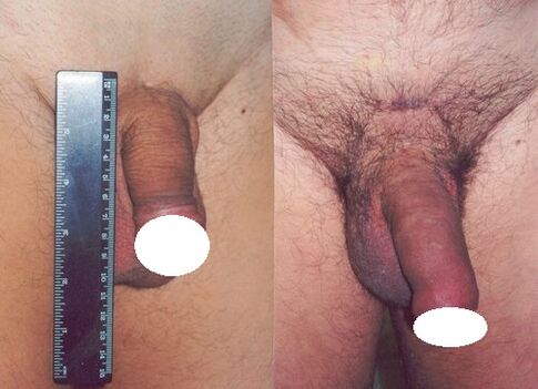 Penis vor und nach dem Anstieg