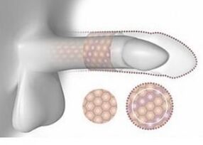 Erhöhung des Penis im Volumen