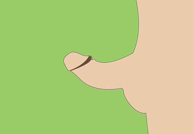 Krümmung des Penis als Indikation für eine chirurgische Vergrößerung